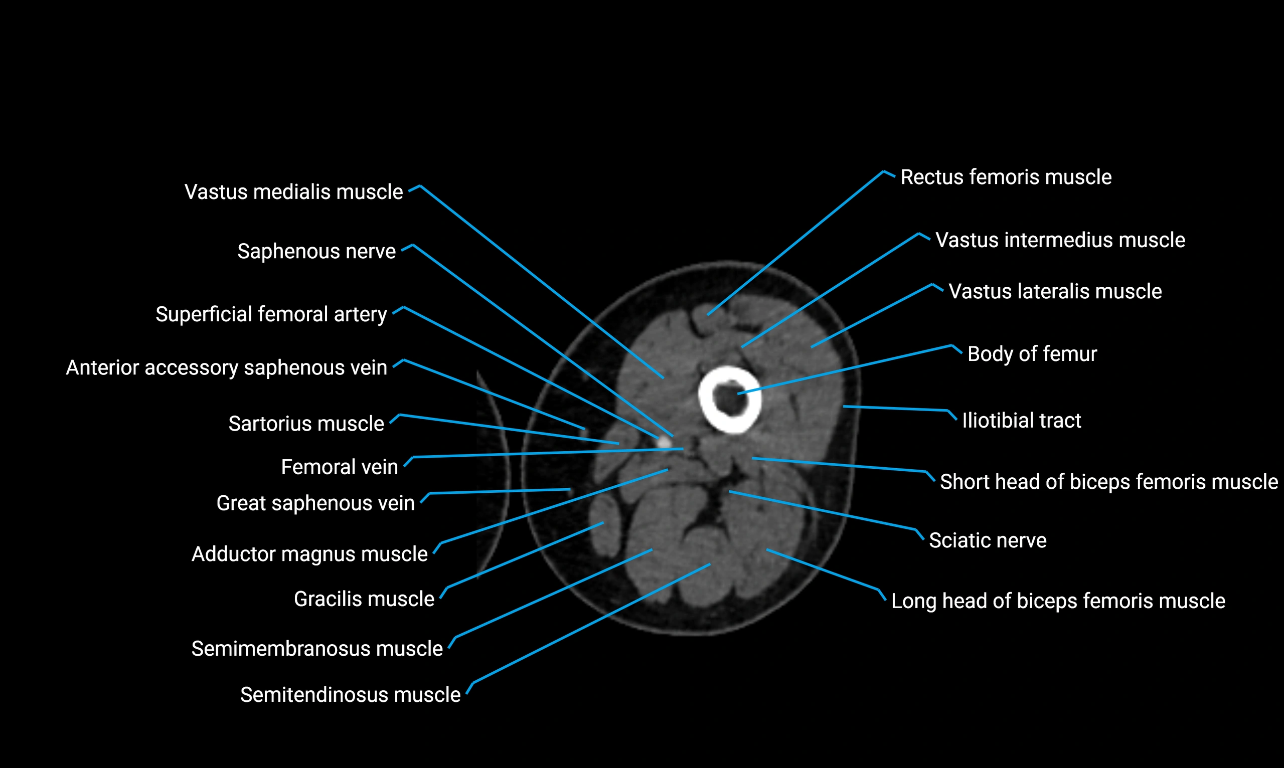 CT lower limb axial cross sectional anatomy labelled image 58 (2).webp